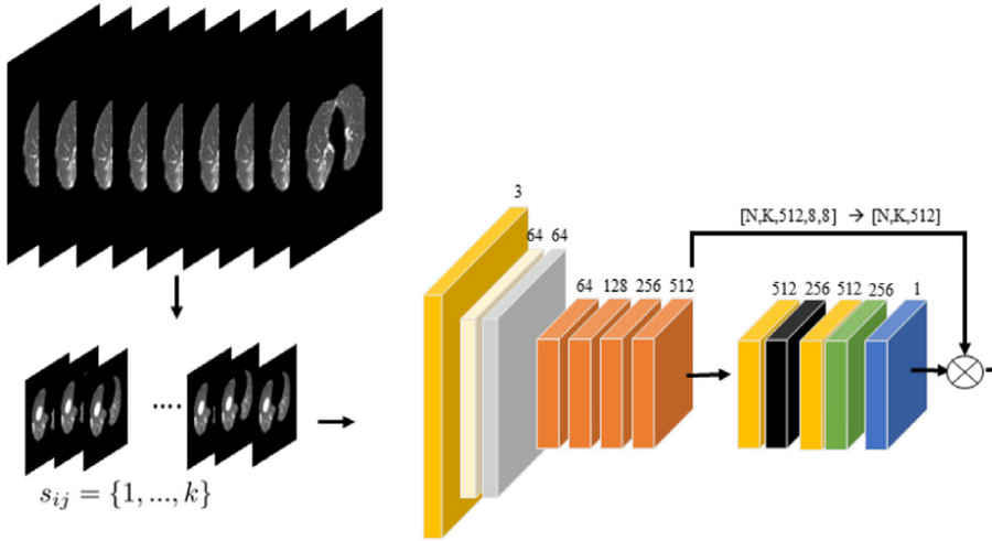 Dual attention multiple instance learning with unsupervised complementary loss for COVID-19 screening