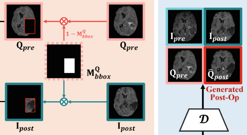 Pre-to-Post Operative MRI Generation with Retrieval-based Visual In-Context Learning